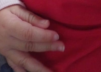 Bebê de 7 meses é internado com costela quebrada e lesão no crânio; mãe é presa em MS